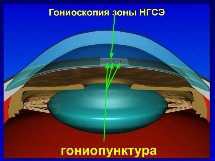 Гониоскопия зоны НГСЭ гониопунктура