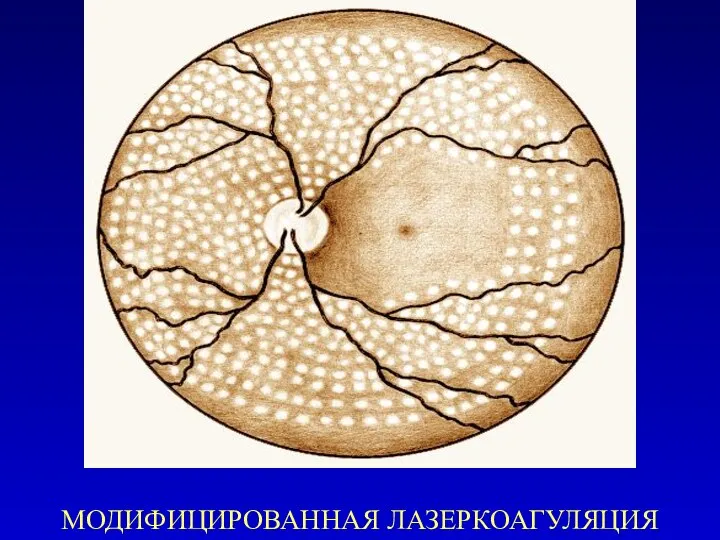 МОДИФИЦИРОВАННАЯ ЛАЗЕРКОАГУЛЯЦИЯ