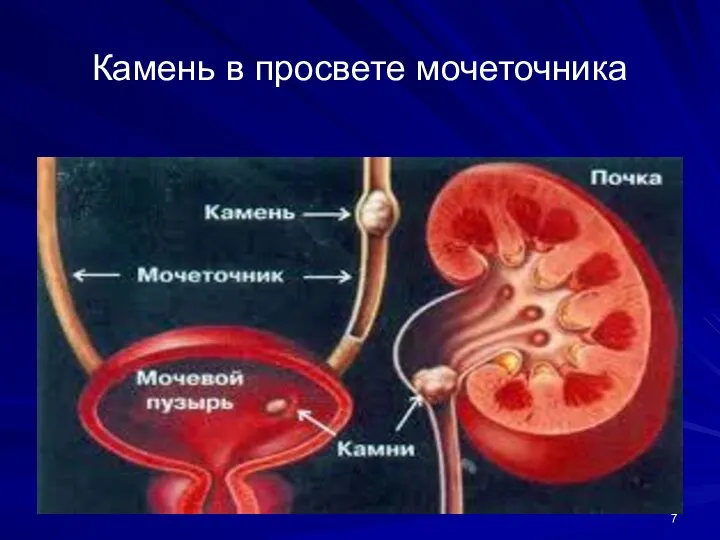 Камень в просвете мочеточника