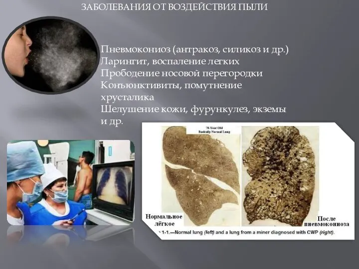 ЗАБОЛЕВАНИЯ ОТ ВОЗДЕЙСТВИЯ ПЫЛИ Пневмокониоз (антракоз, силикоз и др.) Ларингит, воспаление легких