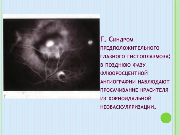 Г. Синдром предположительного глазного гистоплазмоза: в позднюю фазу флюоросцентной ангиографии наблюдают просачивание красителя из хориоидальной неоваскуляризации.