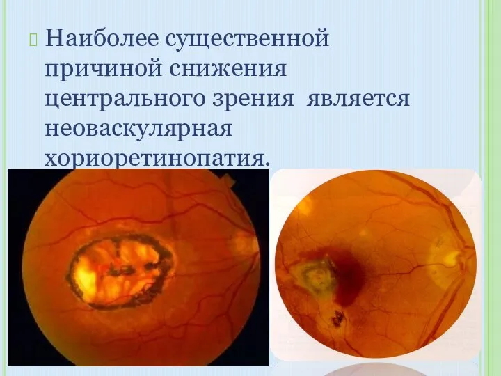 Наиболее существенной причиной снижения центрального зрения является неоваскулярная хориоретинопатия.