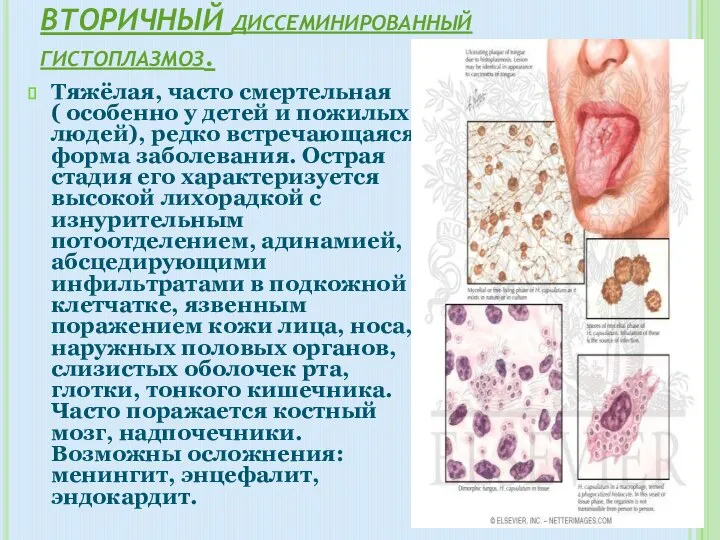 ВТОРИЧНЫЙ диссеминированный гистоплазмоз. Тяжёлая, часто смертельная ( особенно у детей и пожилых