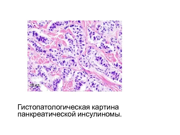 Гистопатологическая картина панкреатической инсулиномы.