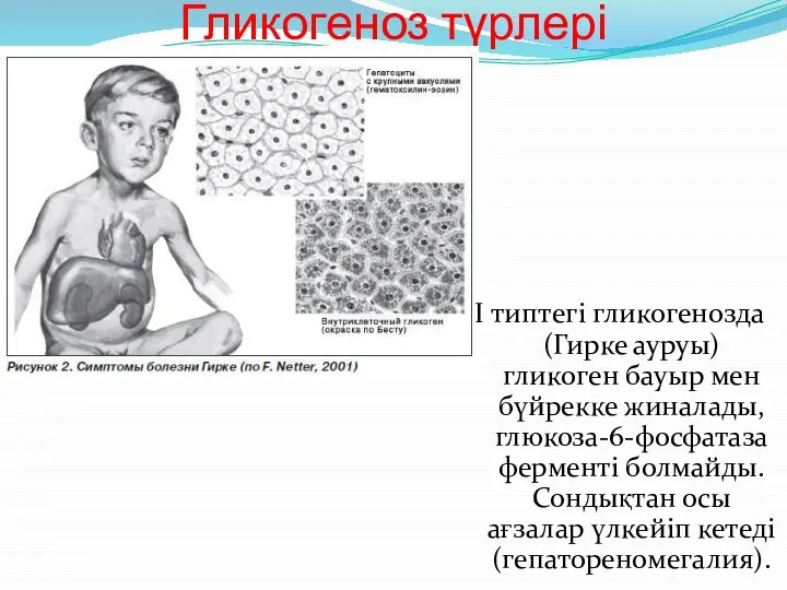 Гликогеноз түрлері І типтегі гликогенозда (Гирке ауруы) гликоген бауыр мен бүйрекке жиналады,