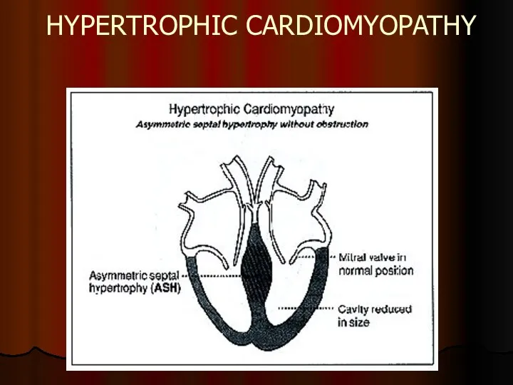 HYPERTROPHIC CARDIOMYOPATHY