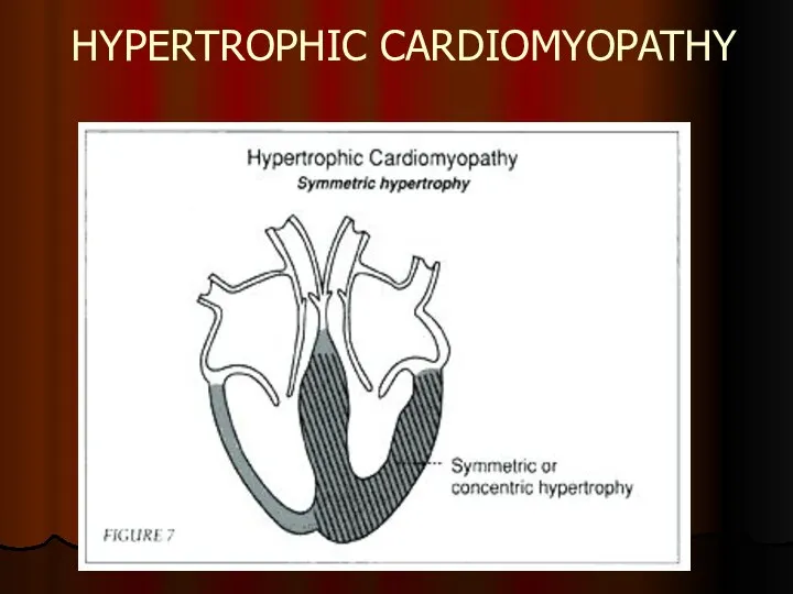 HYPERTROPHIC CARDIOMYOPATHY