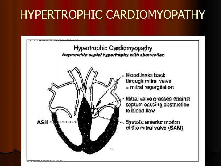 HYPERTROPHIC CARDIOMYOPATHY