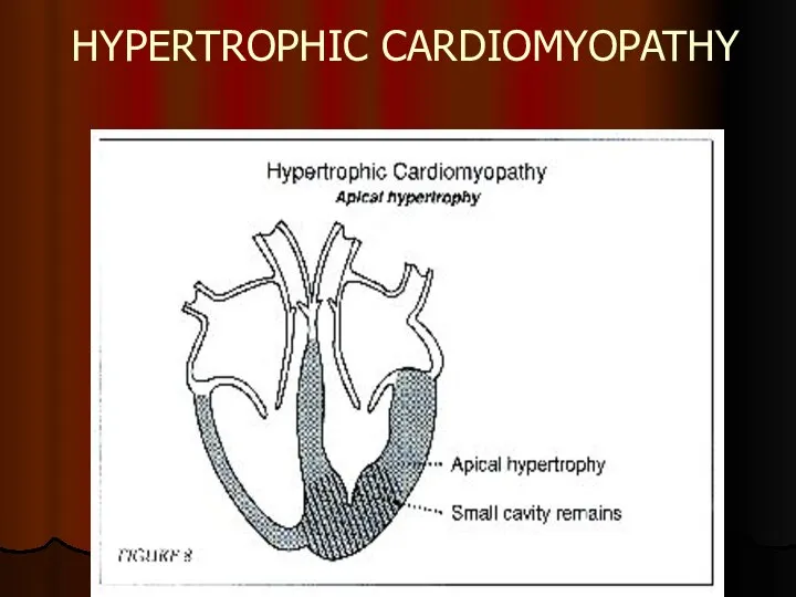 HYPERTROPHIC CARDIOMYOPATHY