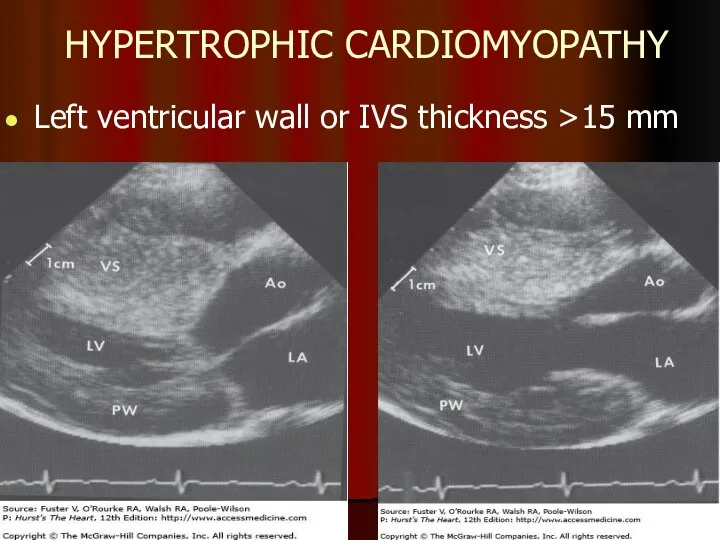 HYPERTROPHIC CARDIOMYOPATHY Left ventricular wall or IVS thickness >15 mm