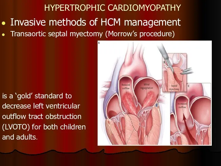 HYPERTROPHIC CARDIOMYOPATHY Invasive methods of HCM management Transaortic septal myectomy (Morrow’s procedure)