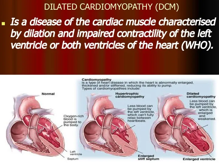 DILATED CARDIOMYOPATHY (DCM) Is a disease of the cardiac muscle characterised by