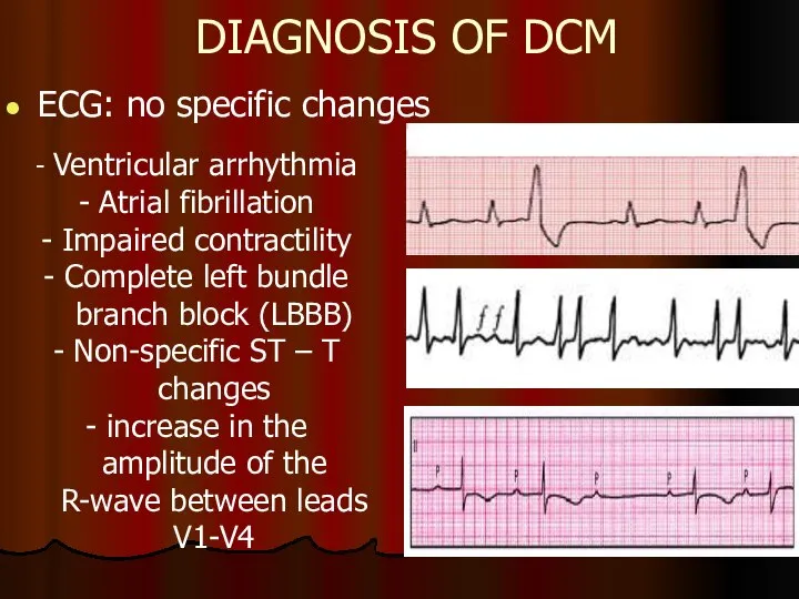 DIAGNOSIS OF DCM ECG: no specific changes - Ventricular arrhythmia - Atrial