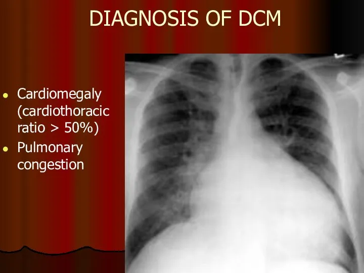 DIAGNOSIS OF DCM Cardiomegaly (cardiothoracic ratio > 50%) Pulmonary congestion