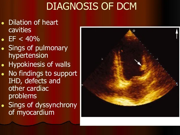 DIAGNOSIS OF DCM Dilation of heart cavities EF Sings of pulmonary hypertension