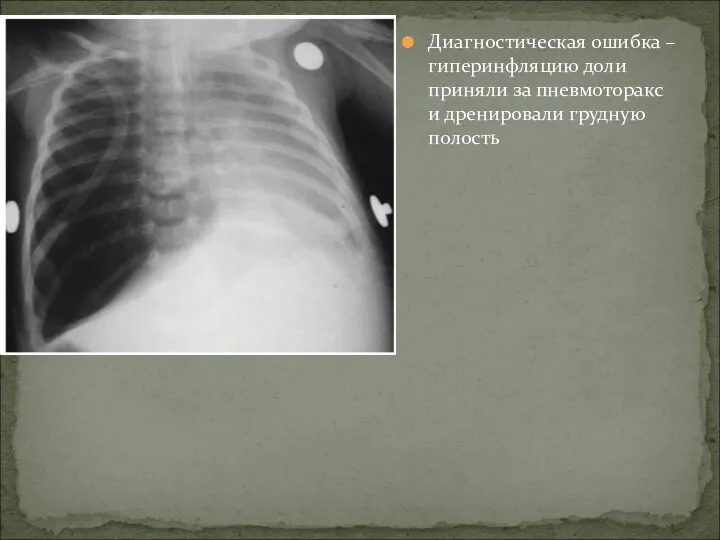 Диагностическая ошибка – гиперинфляцию доли приняли за пневмоторакс и дренировали грудную полость