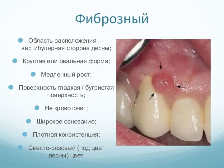 Фиброзный Область расположения — вестибулярная сторона десны; Круглая или овальная форма; Медленный