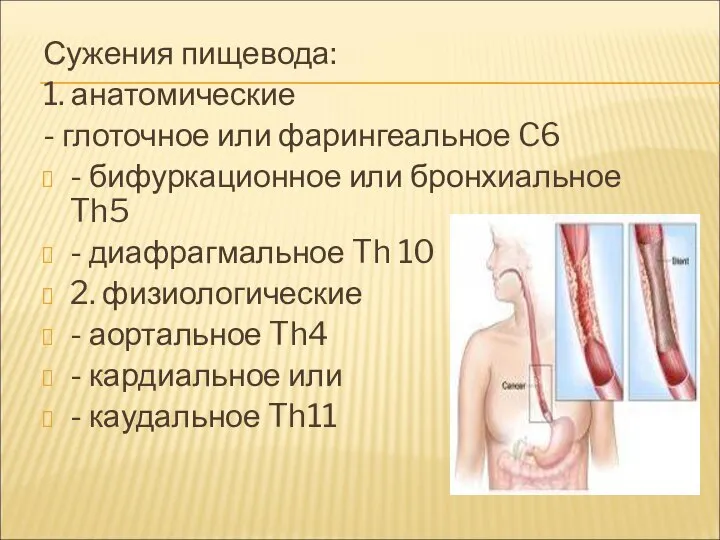 Сужения пищевода: 1. анатомические - глоточное или фарингеальное C6 - бифуркационное или