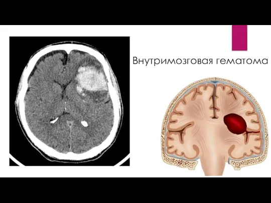 Внутримозговая гематома