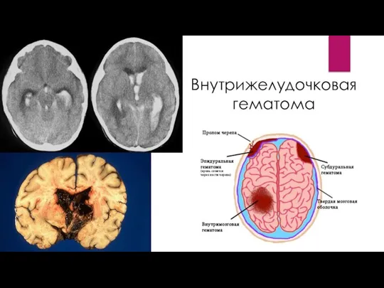 Внутрижелудочковая гематома