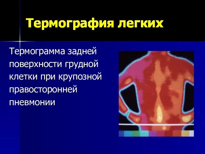 Термография легких Термограмма задней поверхности грудной клетки при крупозной правосторонней пневмонии