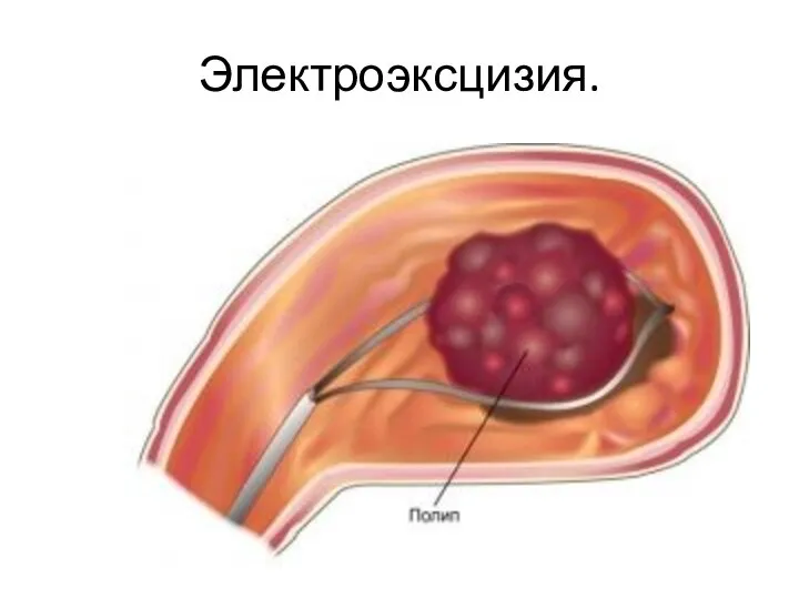 Электроэксцизия.