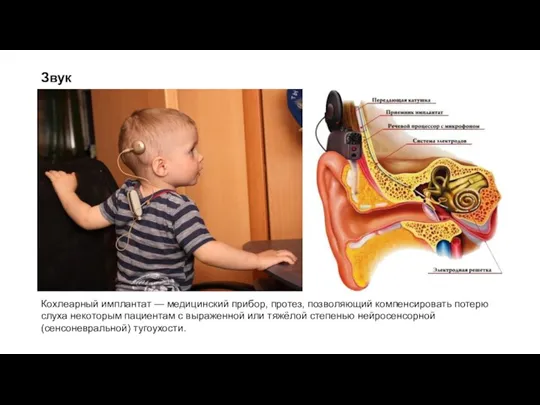 Звук Кохлеарный имплантат — медицинский прибор, протез, позволяющий компенсировать потерю слуха некоторым