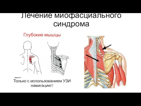 Лечение миофасциального синдрома Только с использованием УЗИ навигации!! Глубокие мышцы