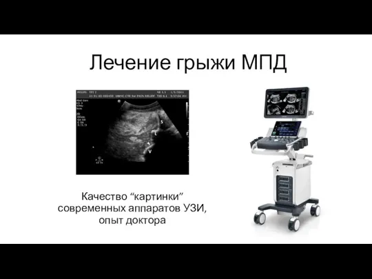 Лечение грыжи МПД Качество “картинки” современных аппаратов УЗИ, опыт доктора
