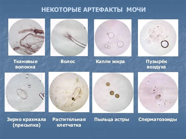 НЕКОТОРЫЕ АРТЕФАКТЫ МОЧИ