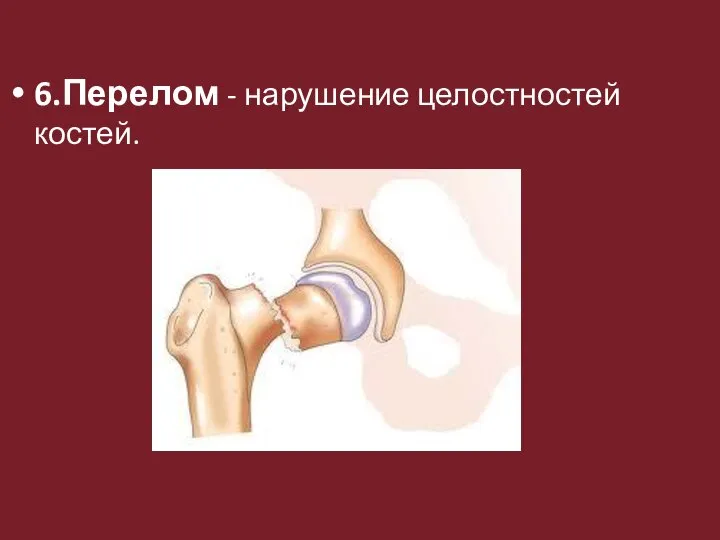 6.Перелом - нарушение целостностей костей.
