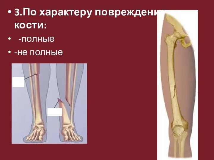 3.По характеру повреждения кости: -полные -не полные