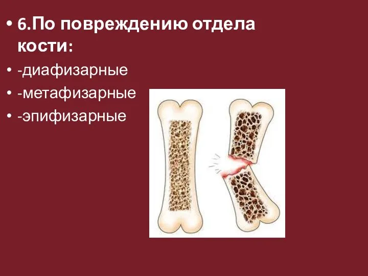 6.По повреждению отдела кости: -диафизарные -метафизарные -эпифизарные