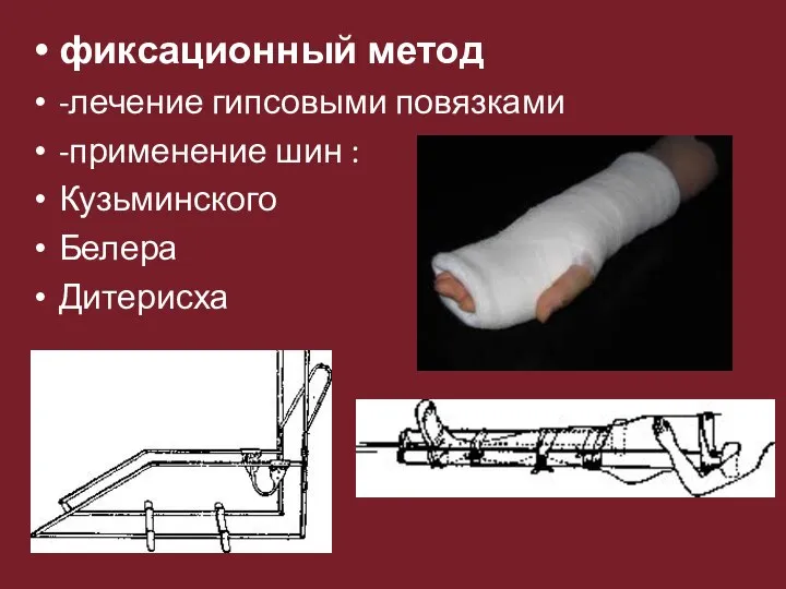 фиксационный метод -лечение гипсовыми повязками -применение шин : Кузьминского Белера Дитерисха