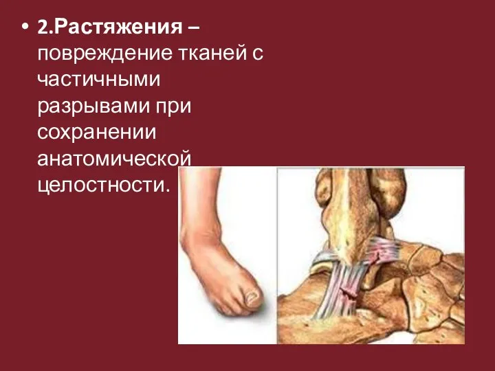 2.Растяжения –повреждение тканей с частичными разрывами при сохранении анатомической целостности.