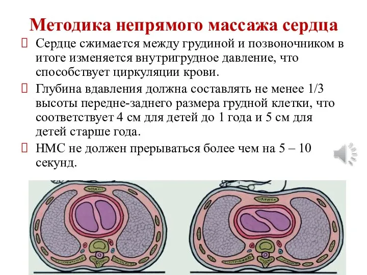 Методика непрямого массажа сердца Сердце сжимается между грудиной и позвоночником в итоге