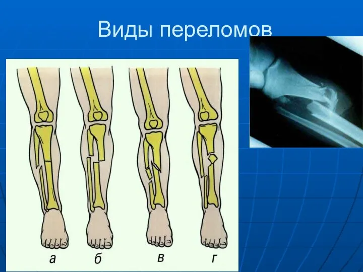 Виды переломов