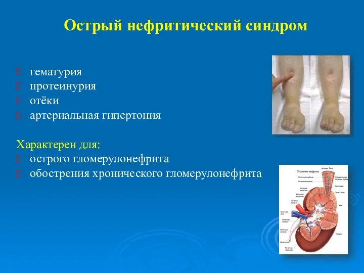 Острый нефритический синдром гематурия протеинурия отёки артериальная гипертония Характерен для: острого гломерулонефрита обострения хронического гломерулонефрита