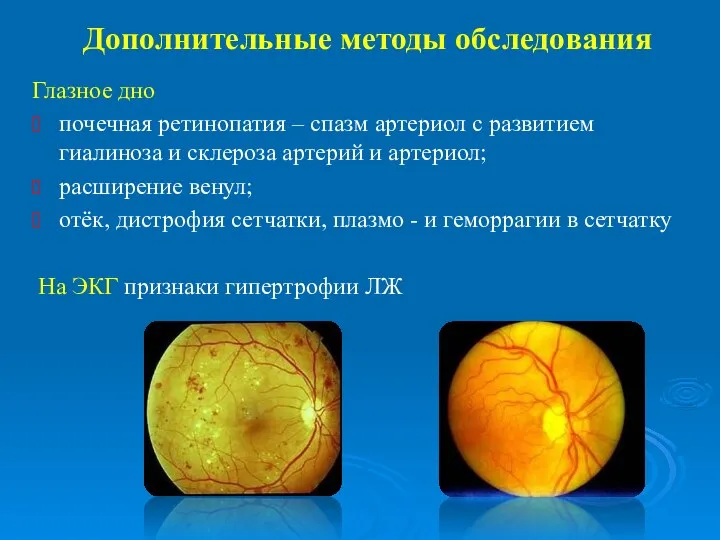 Дополнительные методы обследования Глазное дно почечная ретинопатия – спазм артериол с развитием