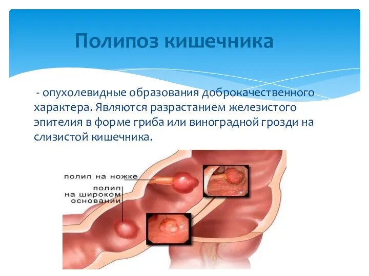 - опухолевидные образования доброкачественного характера. Являются разрастанием железистого эпителия в форме гриба