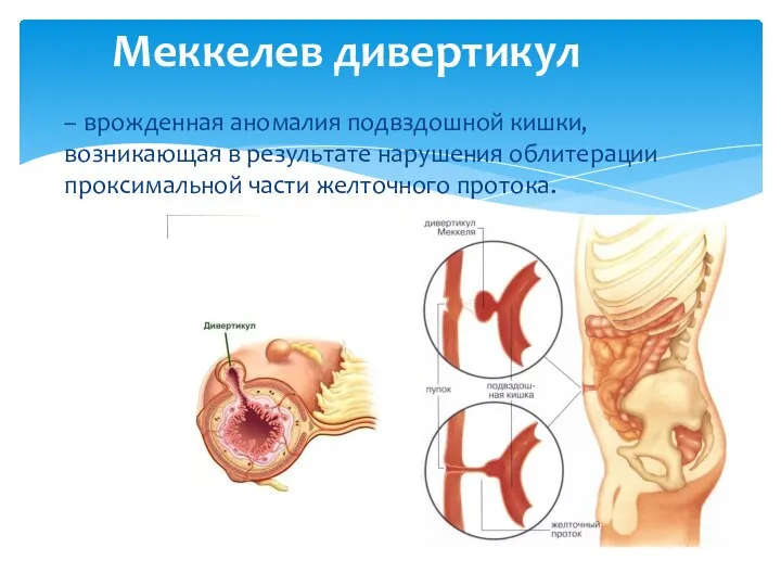 – врожденная аномалия подвздошной кишки, возникающая в результате нарушения облитерации проксимальной части желточного протока. Меккелев дивертикул