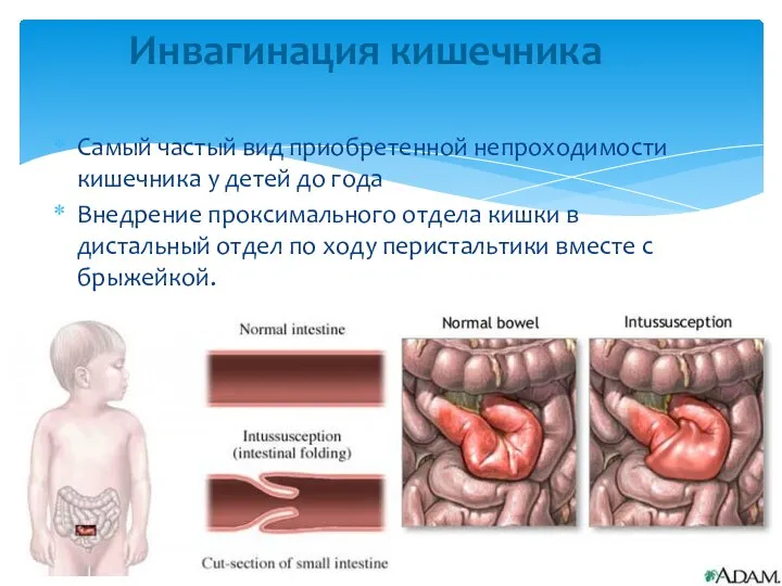 Самый частый вид приобретенной непроходимости кишечника у детей до года Внедрение проксимального