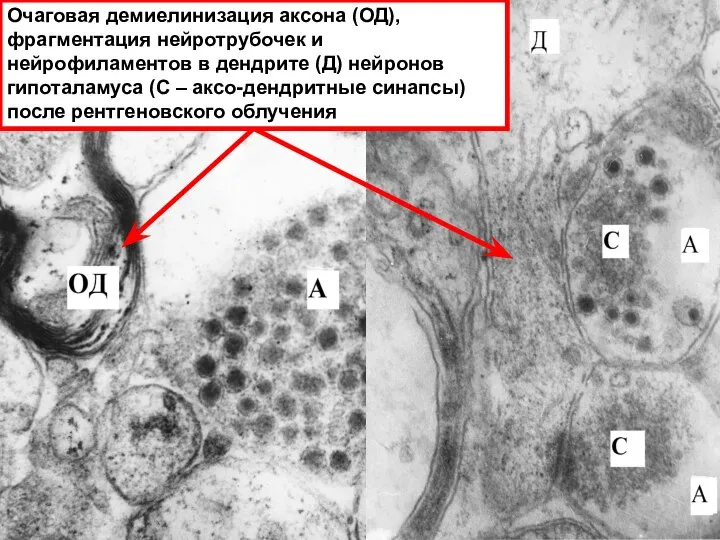 Очаговая демиелинизация аксона (ОД), фрагментация нейротрубочек и нейрофиламентов в дендрите (Д) нейронов