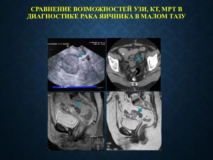 СРАВНЕНИЕ ВОЗМОЖНОСТЕЙ УЗИ, КТ, МРТ В ДИАГНОСТИКЕ РАКА ЯИЧНИКА В МАЛОМ ТАЗУ