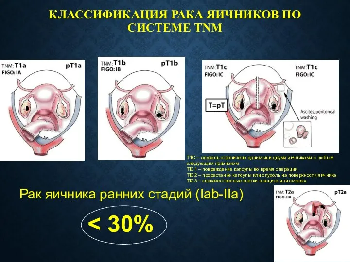 КЛАССИФИКАЦИЯ РАКА ЯИЧНИКОВ ПО СИСТЕМЕ TNM Рак яичника ранних стадий (Iab-IIa) T1C