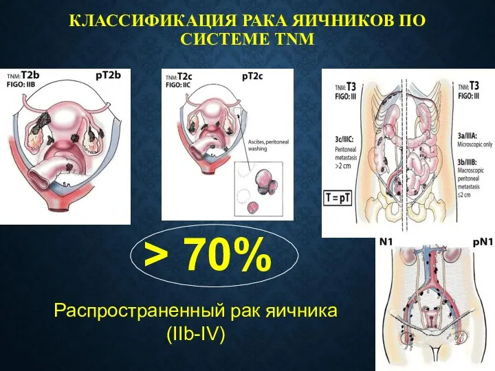 КЛАССИФИКАЦИЯ РАКА ЯИЧНИКОВ ПО СИСТЕМЕ TNM Распространенный рак яичника (IIb-IV) > 70%