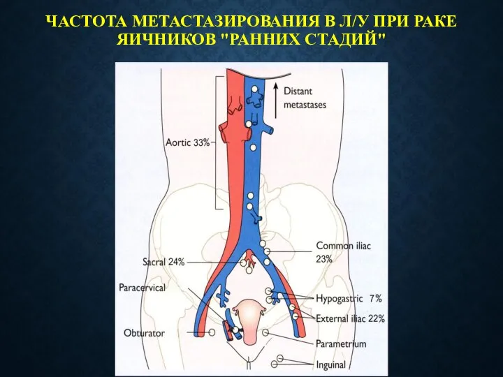 ЧАСТОТА МЕТАСТАЗИРОВАНИЯ В Л/У ПРИ РАКЕ ЯИЧНИКОВ "РАННИХ СТАДИЙ"