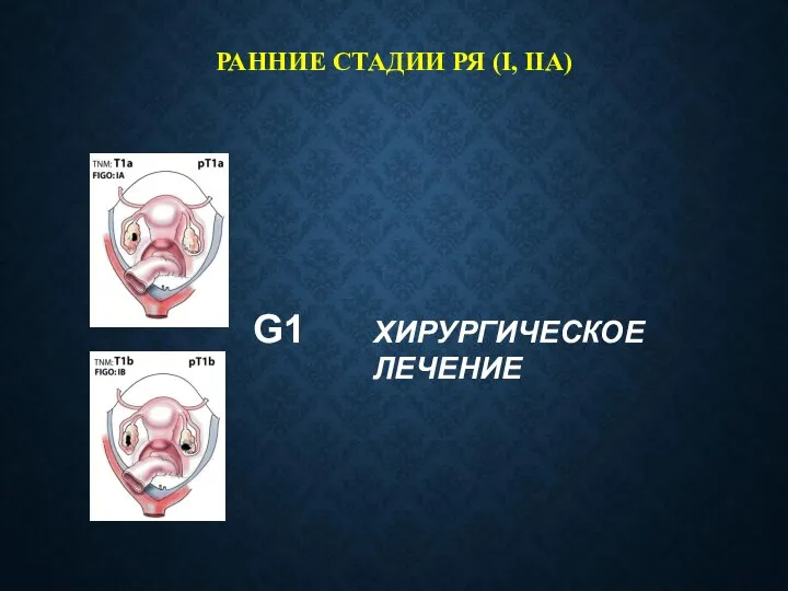 РАННИЕ СТАДИИ РЯ (I, IIA) G1 ХИРУРГИЧЕСКОЕ ЛЕЧЕНИЕ