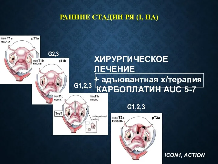 РАННИЕ СТАДИИ РЯ (I, IIA) ХИРУРГИЧЕСКОЕ ЛЕЧЕНИЕ + адъювантная х/терапия КАРБОПЛАТИН AUC