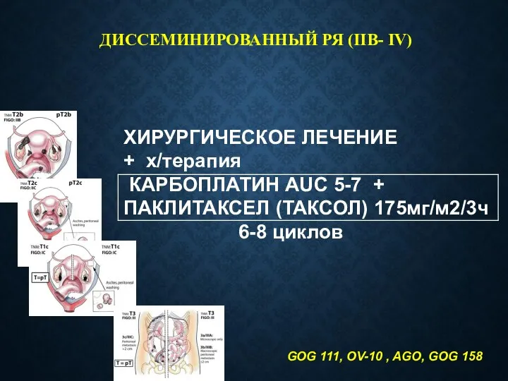 ДИССЕМИНИРОВАННЫЙ РЯ (IIВ- IV) ХИРУРГИЧЕСКОЕ ЛЕЧЕНИЕ + х/терапия КАРБОПЛАТИН AUC 5-7 +